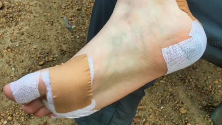 A teen foot with blisters